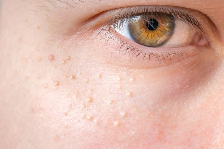 An image of milia under the eye.
