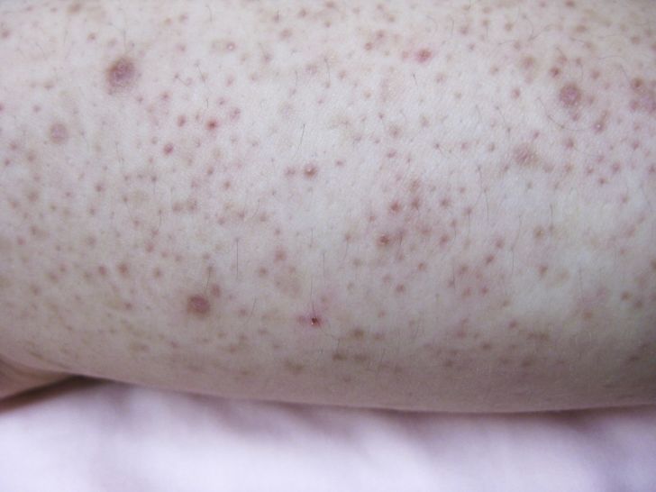 An image of keratosis pilaris.