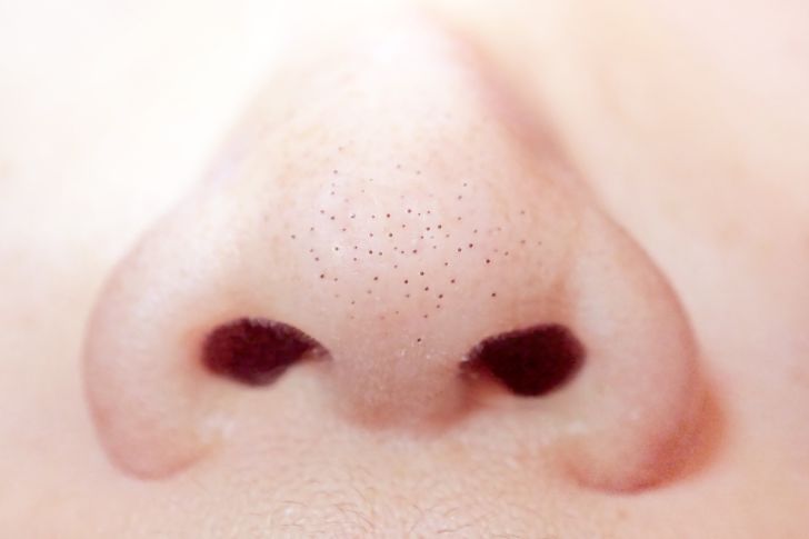 A closeup image of blackheads on the nose.
