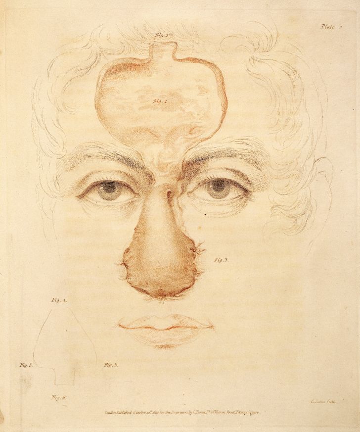 An 1816 image from a nose surgery using the Indian method