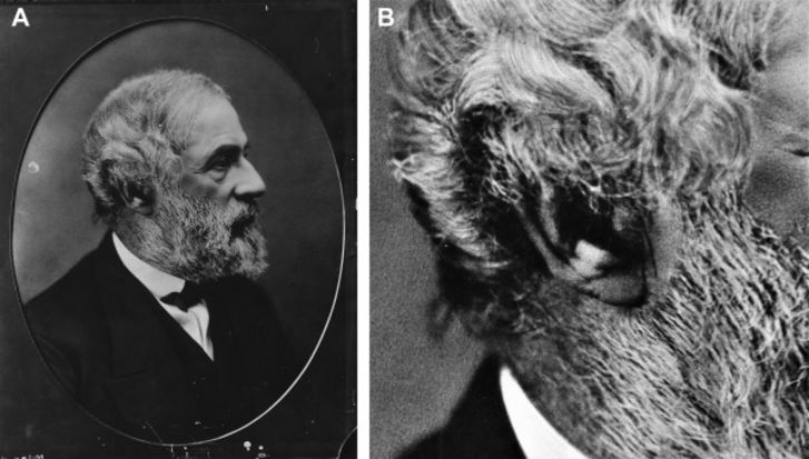 Photo of Robert E. Lee showing a crease in his right earlobe Photo of Robert E. Lee showing a crease in his right earlobe